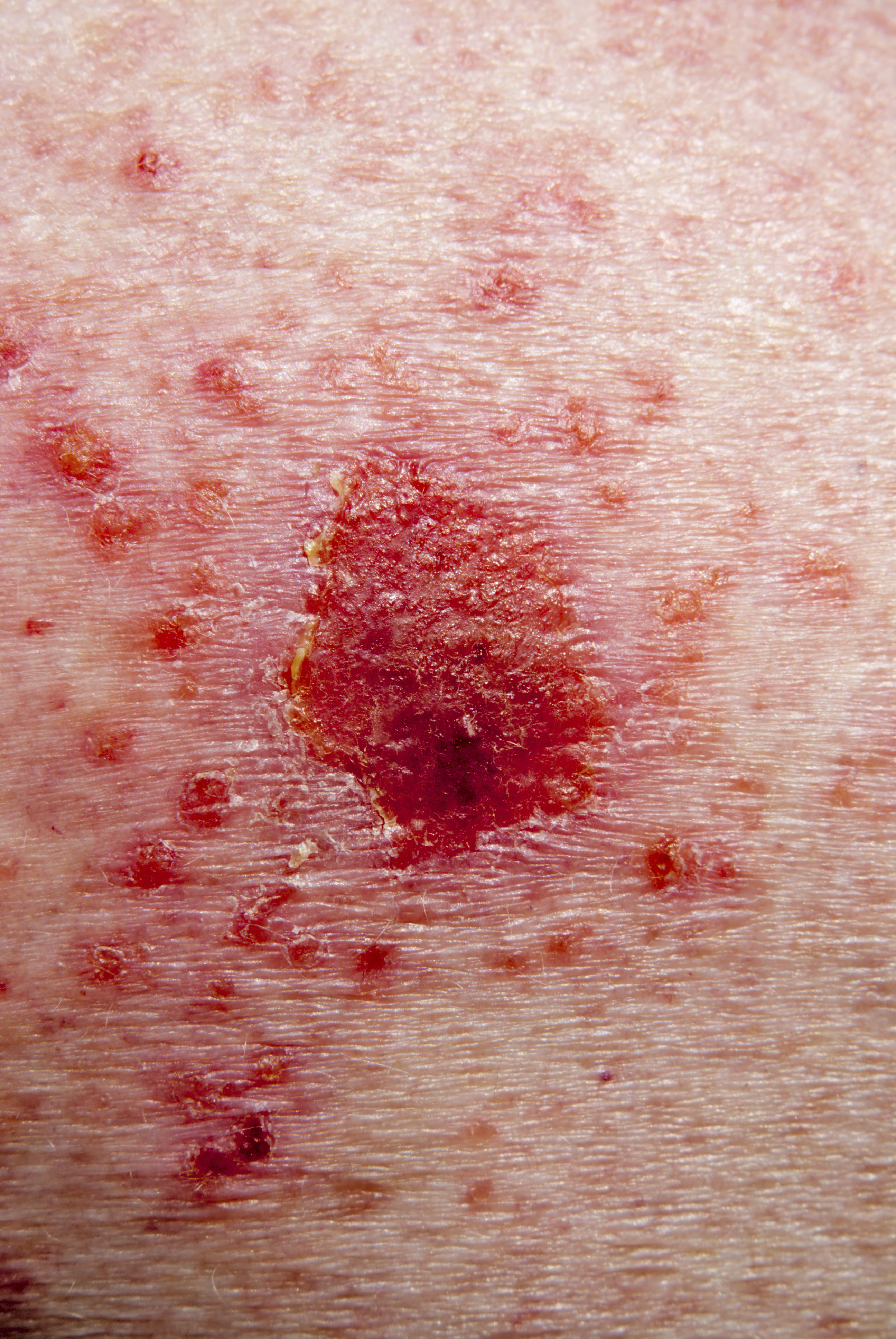 Skin Cancer Early Stage Skin Cancer