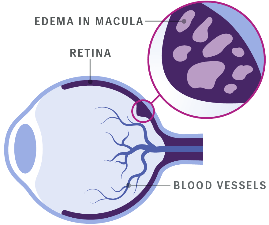 Diagram showing how fluid leakage from UME affects the retina