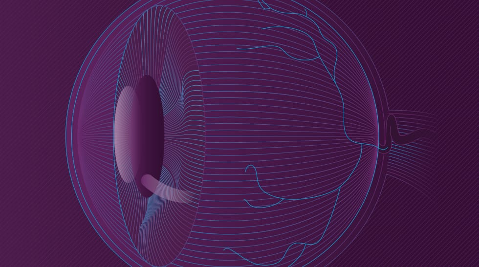 Understanding Wet AMD