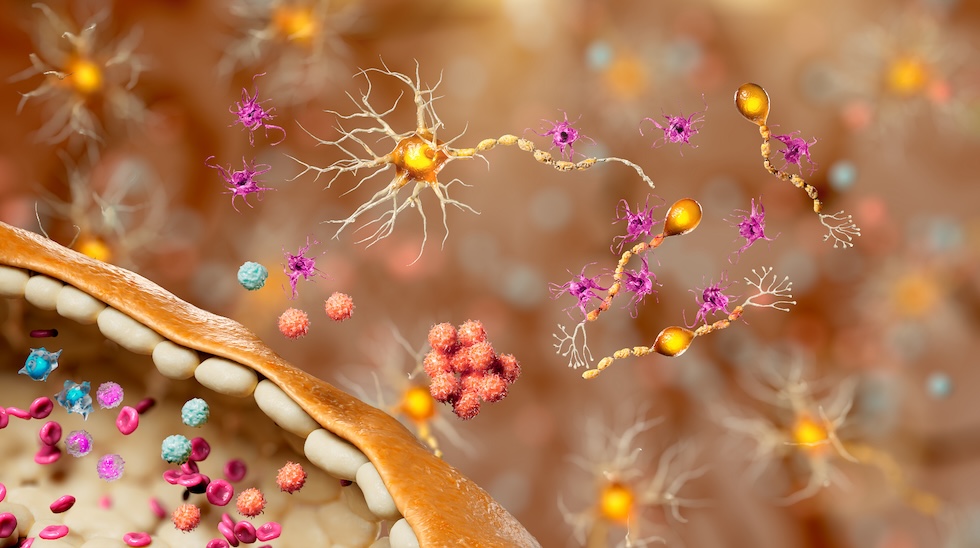 Genentech: Understanding Relapsing and Progressive Biology in MS
